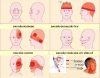 5 loại đau đầu thường gặp và cách chữa trị