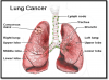 7 dấu hiệu ung thư phổi